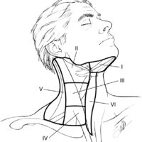 Sensorineural Hearing Loss