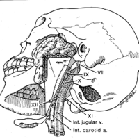 Meniere’s Disease