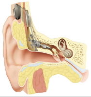 Sensorineural Hearing Loss