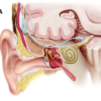 Meniere’s Disease